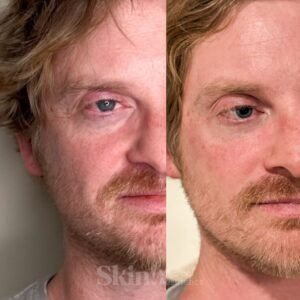 Aerolase Neo laser for melasma and hyperpigmentation at Skin! Medical Aesthetics in Denver 80205.