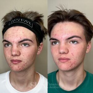 Teenager hormonal acne before and after results from acne treatment protocol at Skin! Medical Aesthetics in Denver 80205 with laser, peels, and skin care.