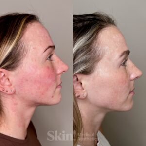 Aerolase Neo laser treatment at Skin! Medical Aesthetics in Denver 80205 for redness, rosacea, and post-inflammatory erythema to calm and clear skin
