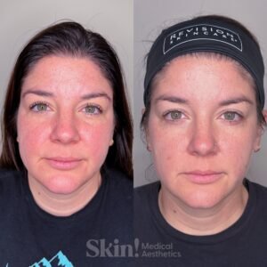 Aerolase Neo laser treatment for rosacea and redness at Skin! Medical Aesthetics in Denver 80205.