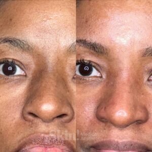 Aerolase Neo laser for melasma and hyperpigmentation at Skin! Medical Aesthetics in Denver 80205.