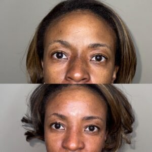 Aerolase Neo laser for melasma and hyperpigmentation at Skin! Medical Aesthetics in Denver 80205