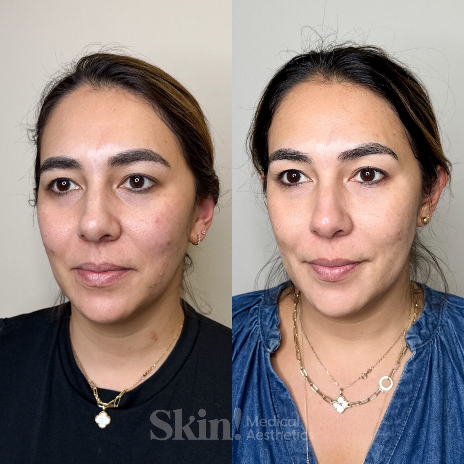 Biostimulator and dermal filler treatments in Denver 80205 at Skin! Medical Aesthetics for natural collagen restoration and facial rejuvenation.