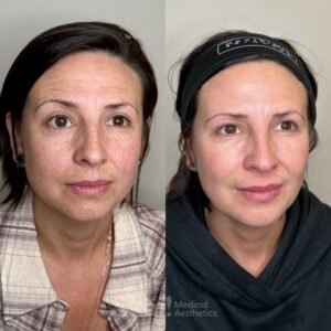 Aerolase Neo skin rejuvenation laser at Skin! Medical Aesthetics in Denver 80205 to improve tone, texture, and radiance.