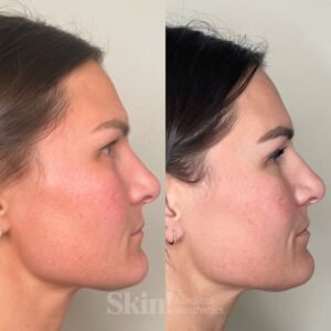 Aerolase Neo laser treatment for rosacea and redness at Skin! Medical Aesthetics in Denver 80205