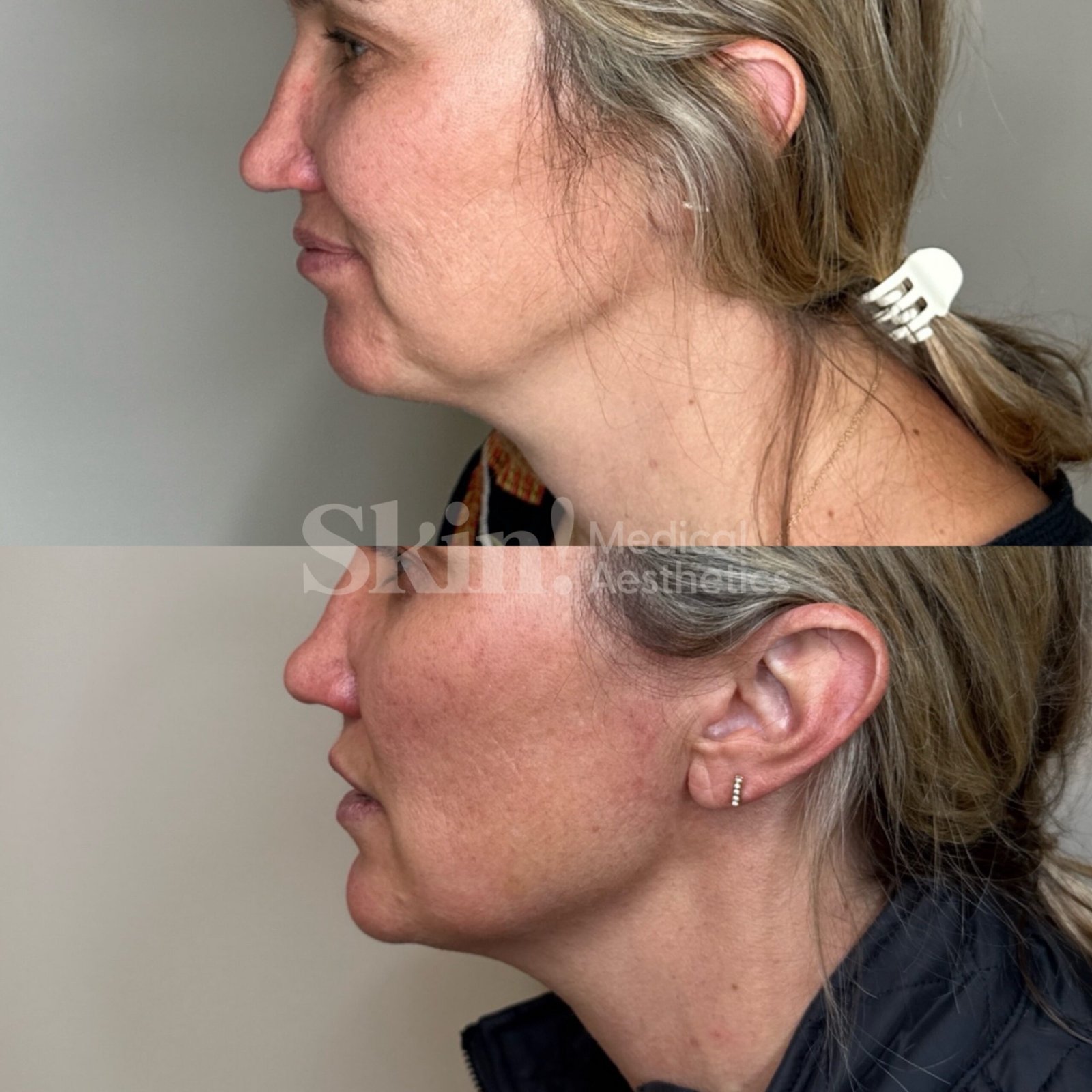 Neck Botox treatment in Denver 80205 at Skin! Medical Aesthetics to smooth lines, reduce bands, and rejuvenate the neck area.