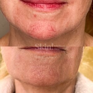 Aerolase Neo laser treatment at Skin! Medical Aesthetics in Denver 80205 for facial spider veins and broken capillaries.