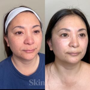 Aerolase Neo laser treatment for melasma and hyperpigmentation at Skin! Medical Aesthetics in Denver 80205 to safely brighten and even skin tone
