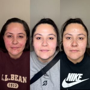 Before and after inflammatory cystic acne treatment protocol at Skin! Medical Aesthetics in Denver 80205 using Aerolase Neo laser, chemical peels, and microneedling.