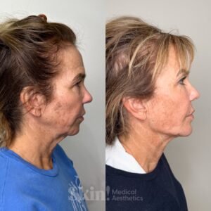 Aerolase Neo laser anti-aging and pigmentation treatment at Skin! Medical Aesthetics in Denver 80205 for smoother, brighter, youthful skin