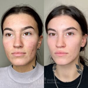 Aerolase Neo laser skin rejuvenation at Skin! Medical Aesthetics in Denver 80205 to improve texture, tone, and pigmentation for radiant skin.