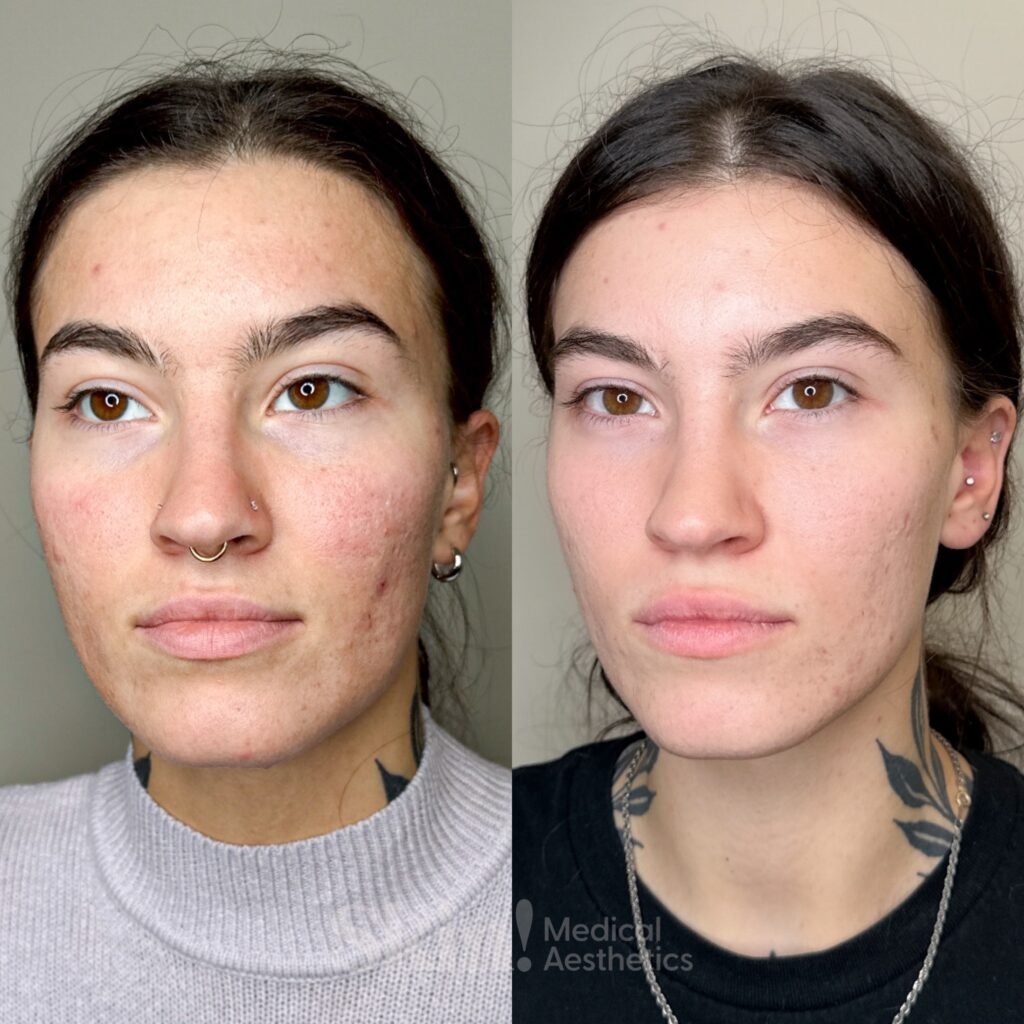 Acne treatment results in Denver 80205 at Skin! Medical Aesthetics showing before and after of cystic acne protocol with lasers, peels, and microneedling