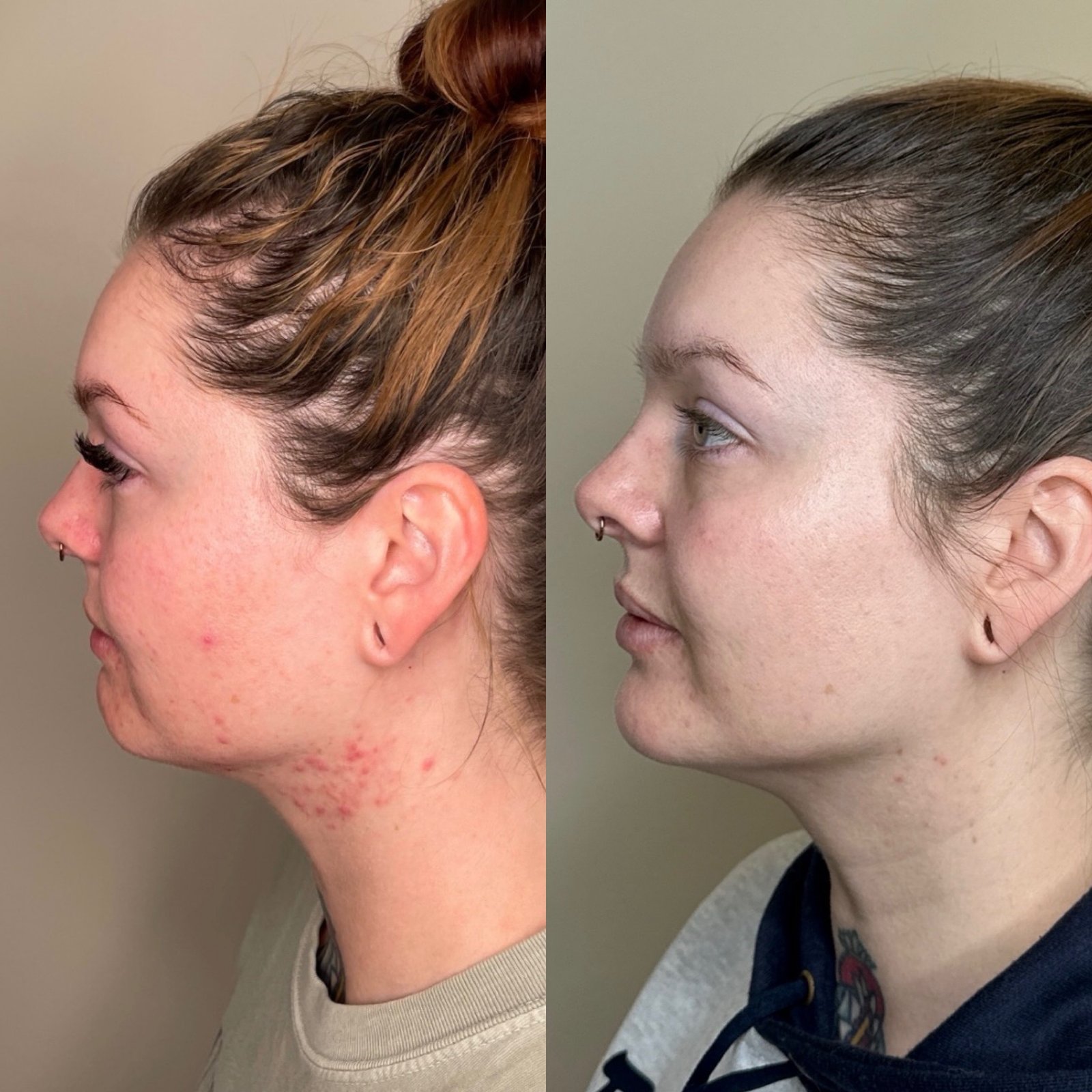 SkinPen microneedling device at Skin! Medical Aesthetics