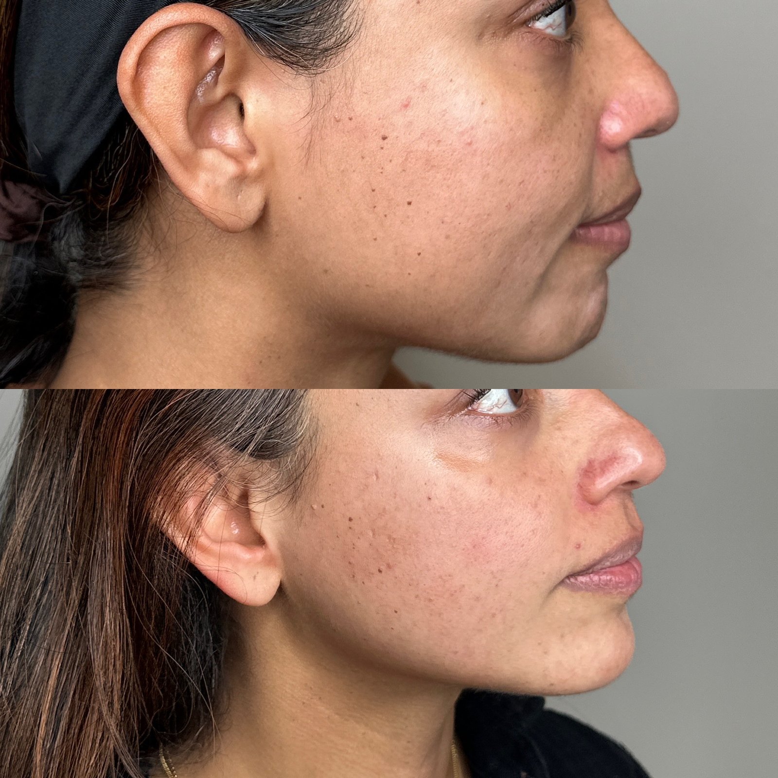 Neurotoxin before and after in Denver — Nefertiti neck lift and jawline