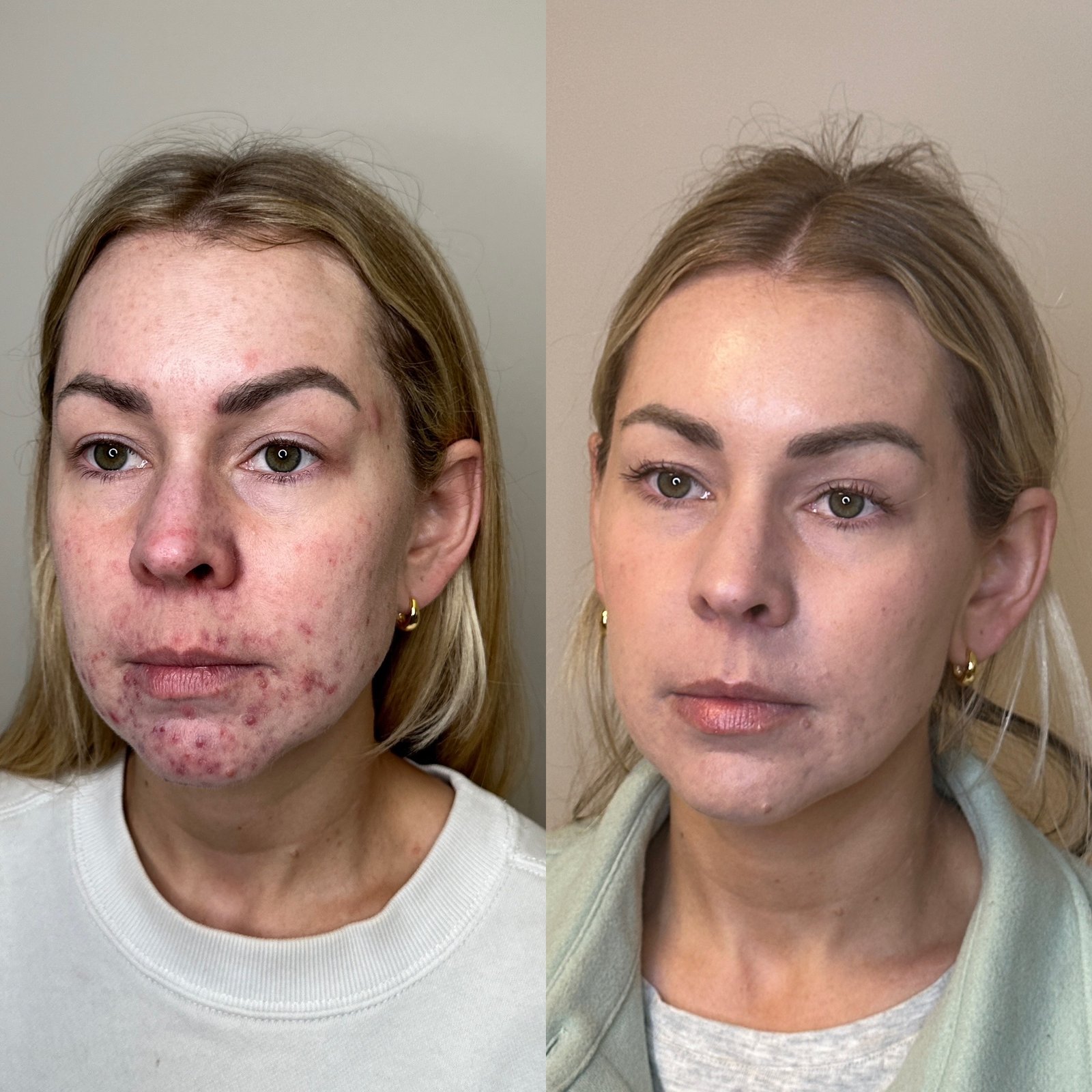 SkinPen microneedling before and after — texture and pores
