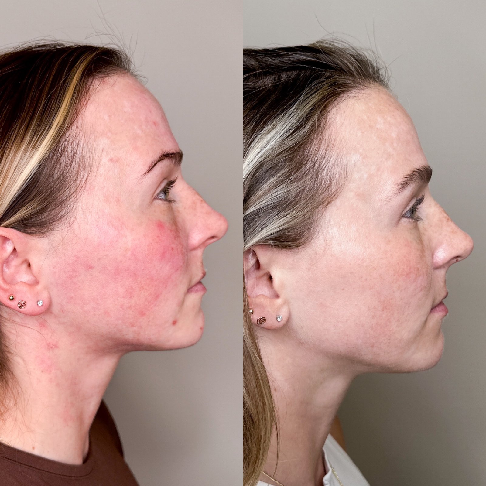 Aerolase Neo Elite before and after — rosacea and flushing