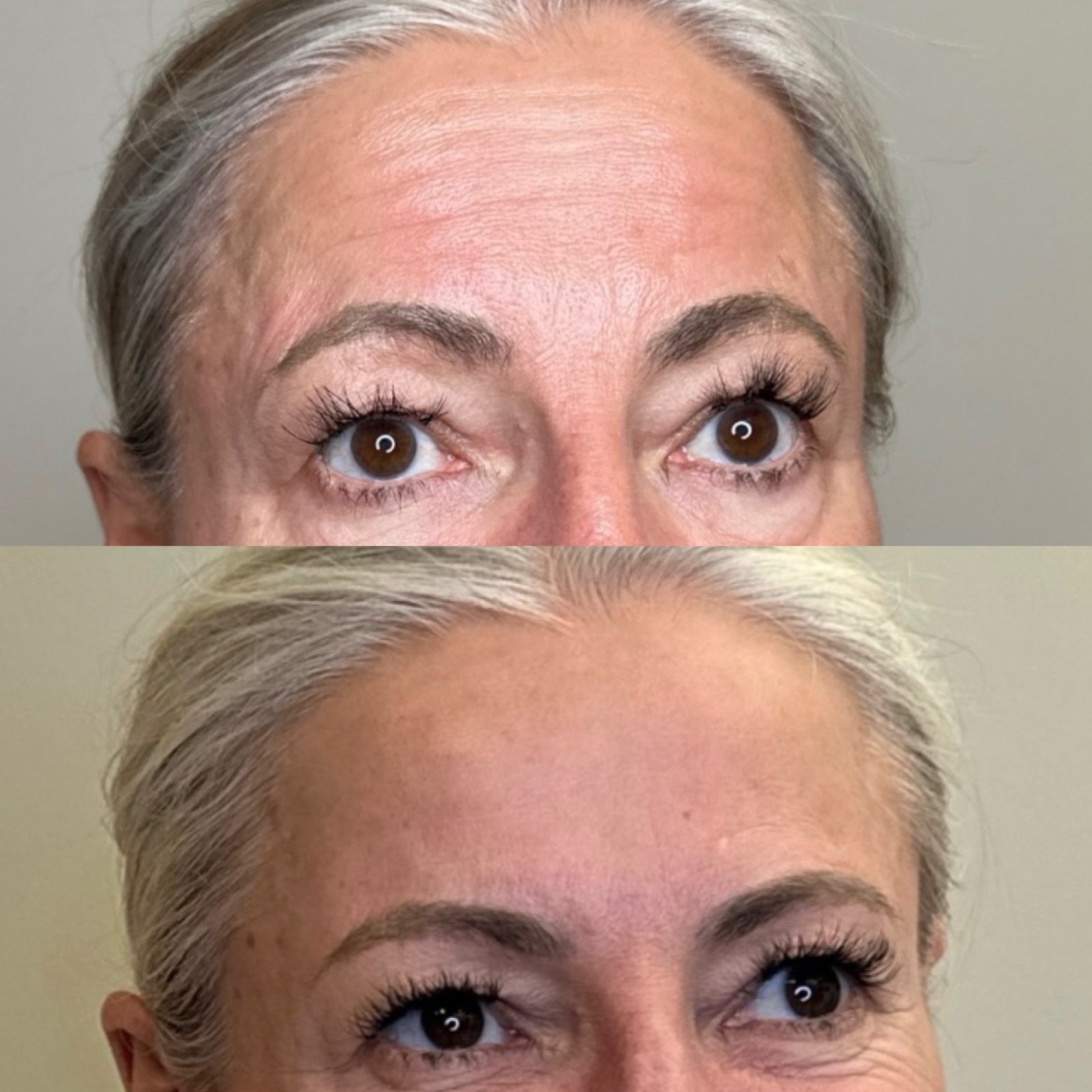 Neurotoxin before and after in Denver — forehead and glabella