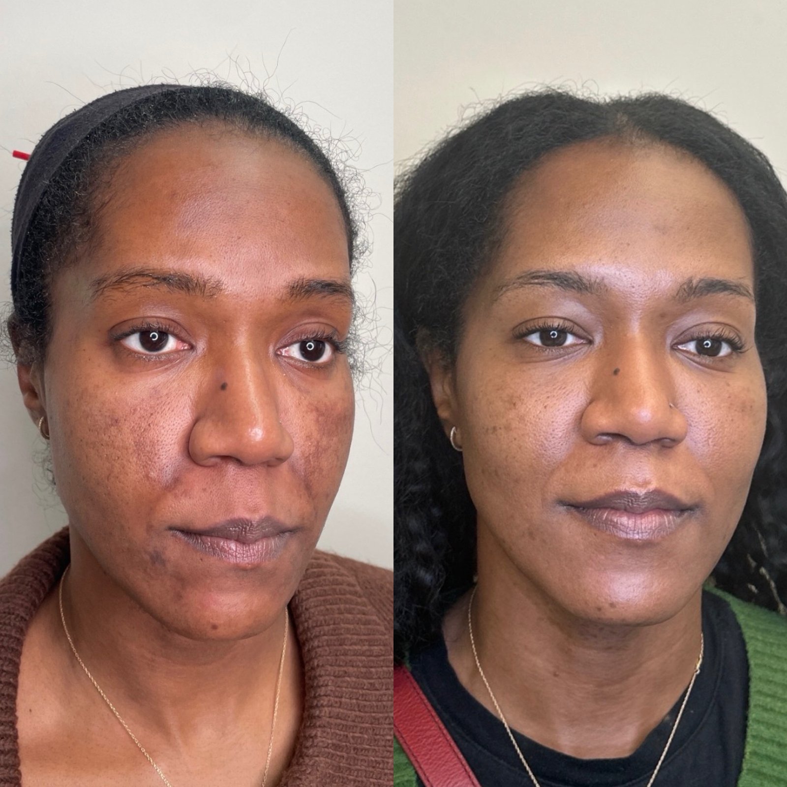 Melasma treatment before and after in Denver — hormonal melasma