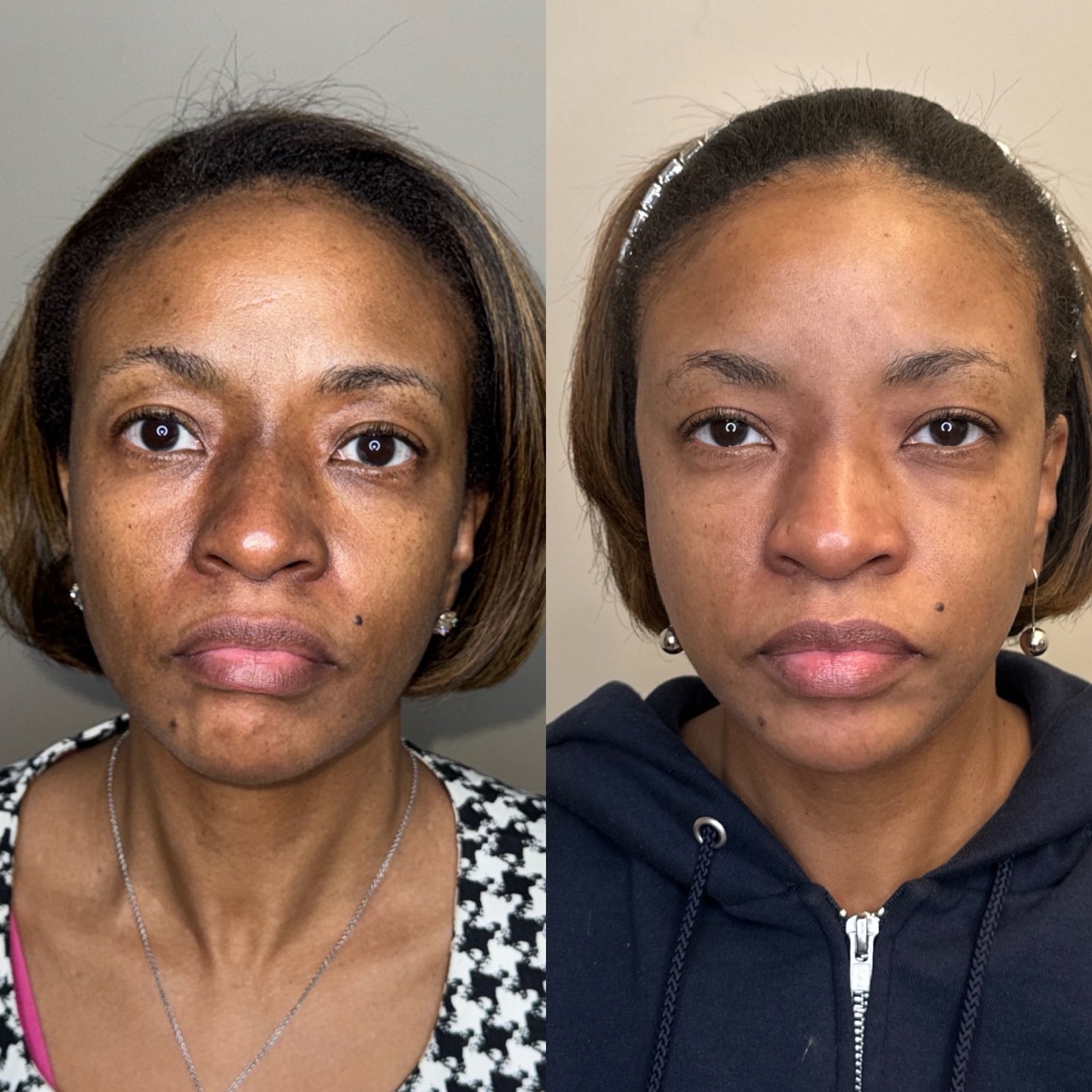 Melasma treatment before and after in Denver — centrofacial pattern