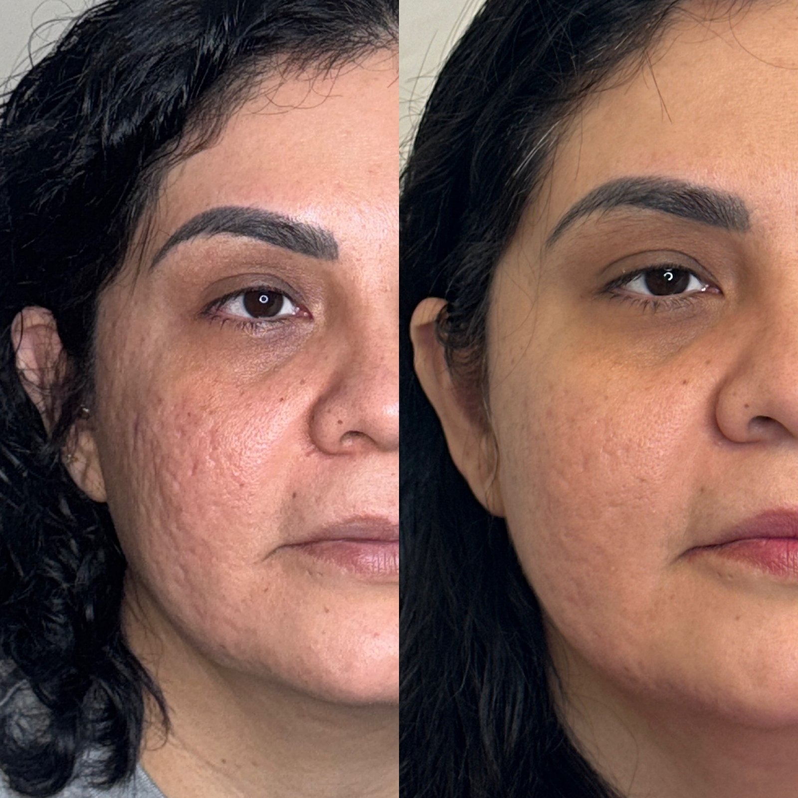 Microneedling safe for all skin tones in Denver