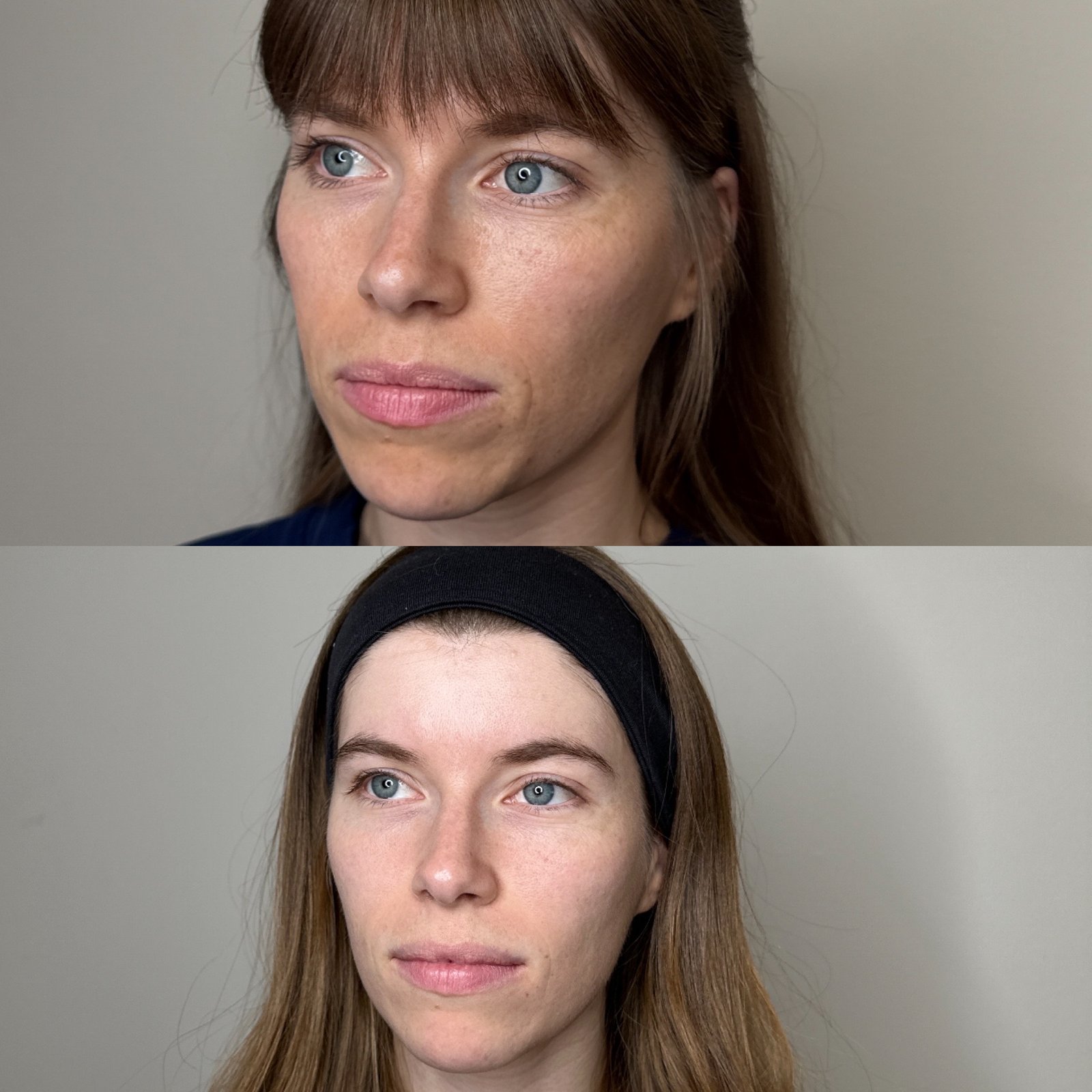 Melasma treatment before and after in Denver — upper lip pigment