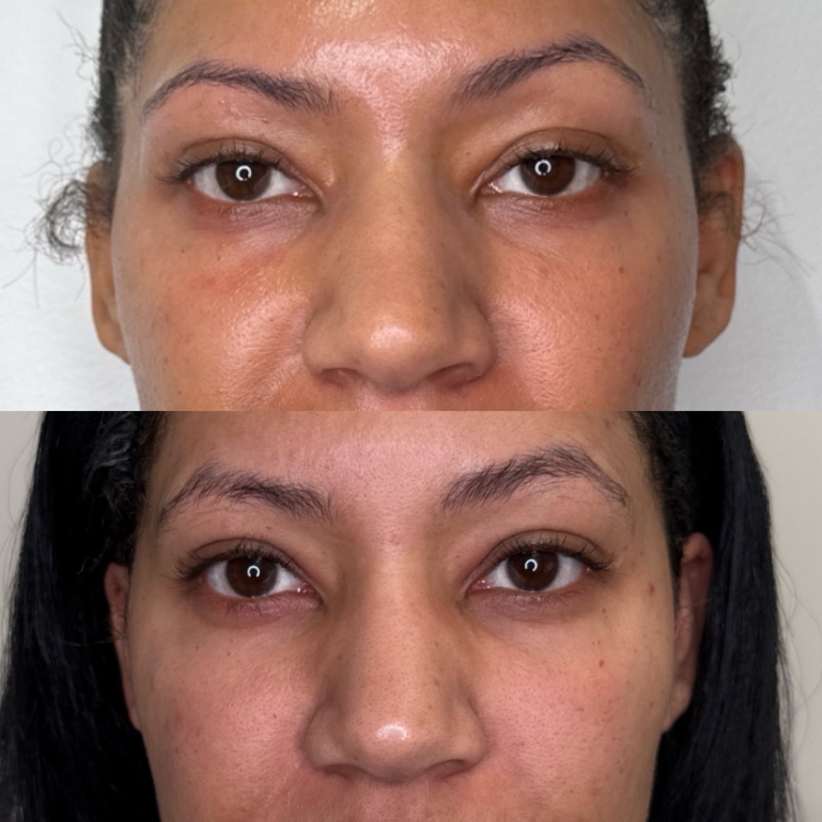 EZ Gel PRF before and after in Denver — under-eye hollowing