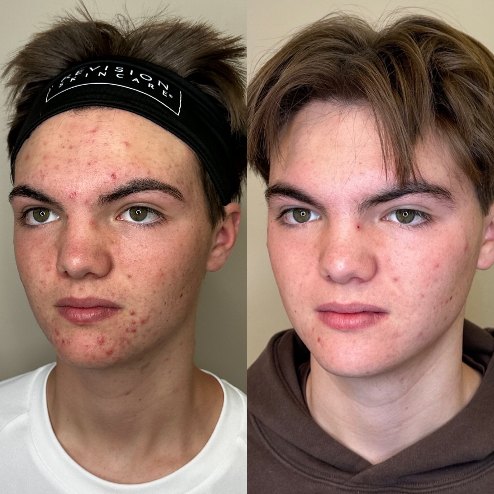 Aerolase Neo Elite before and after — active acne and redness