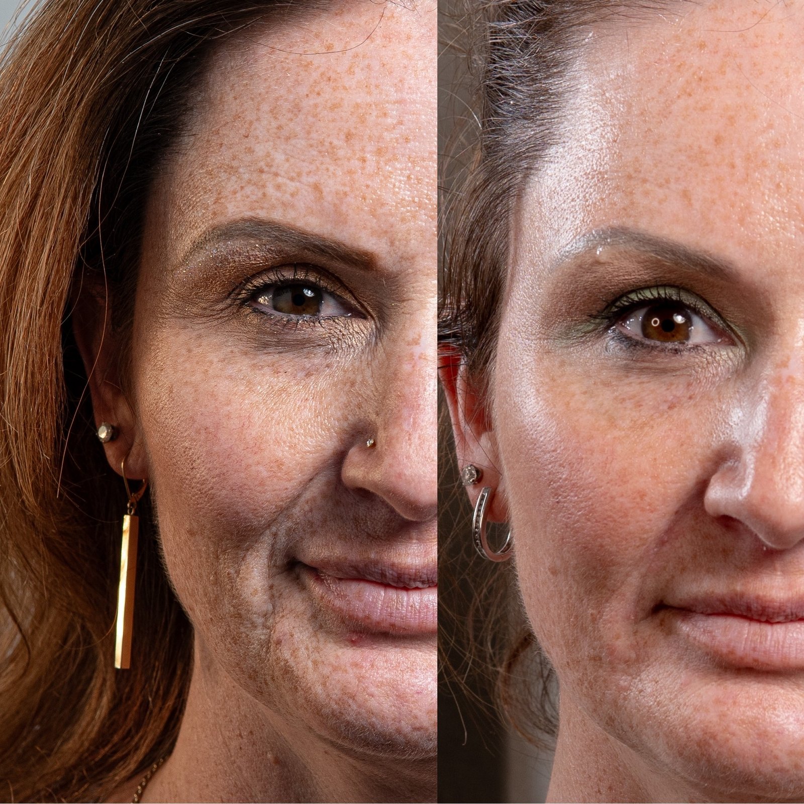 Neurotoxin before and after in Denver — full face and neck