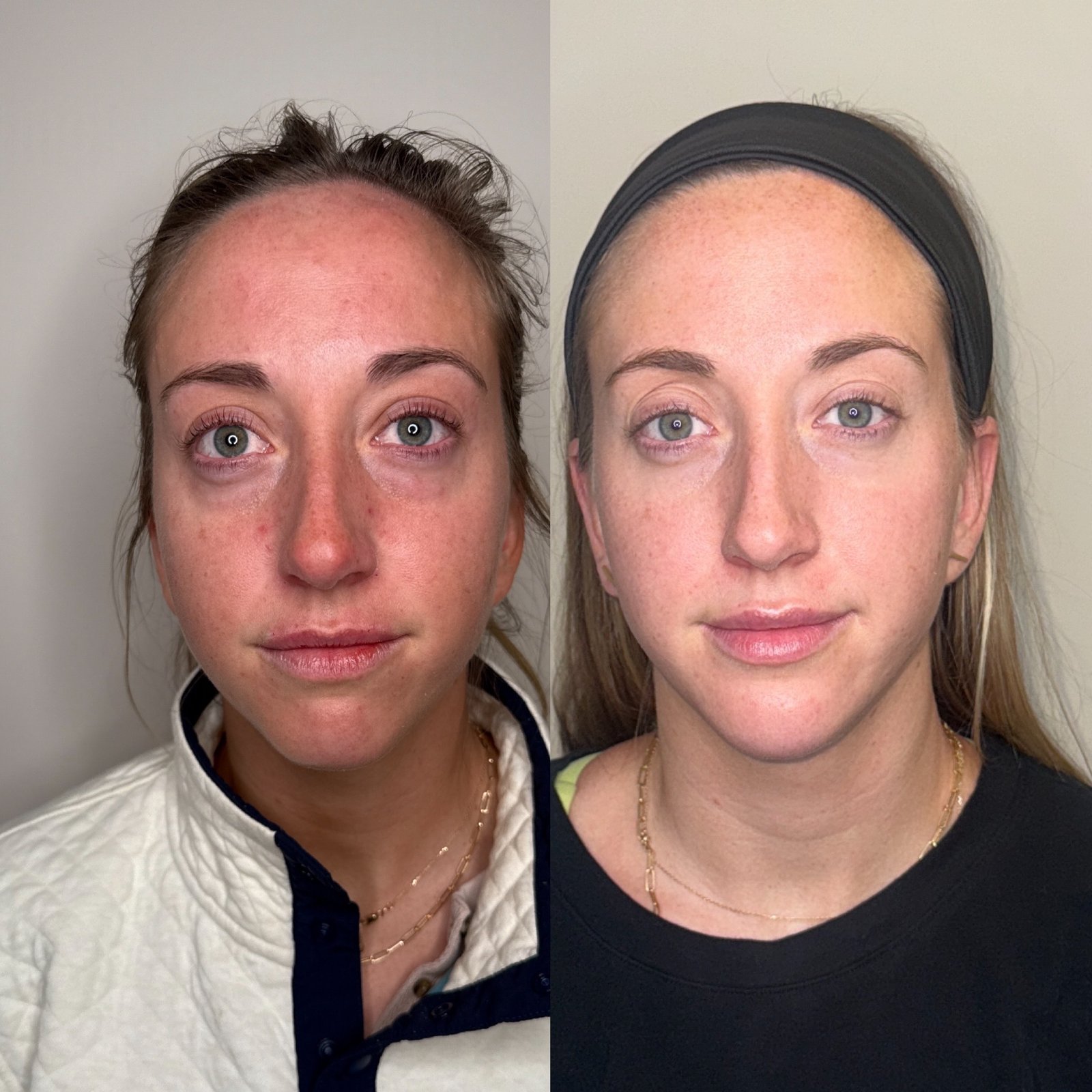 EZ Gel PRF before and after in Denver — mid-face skin quality