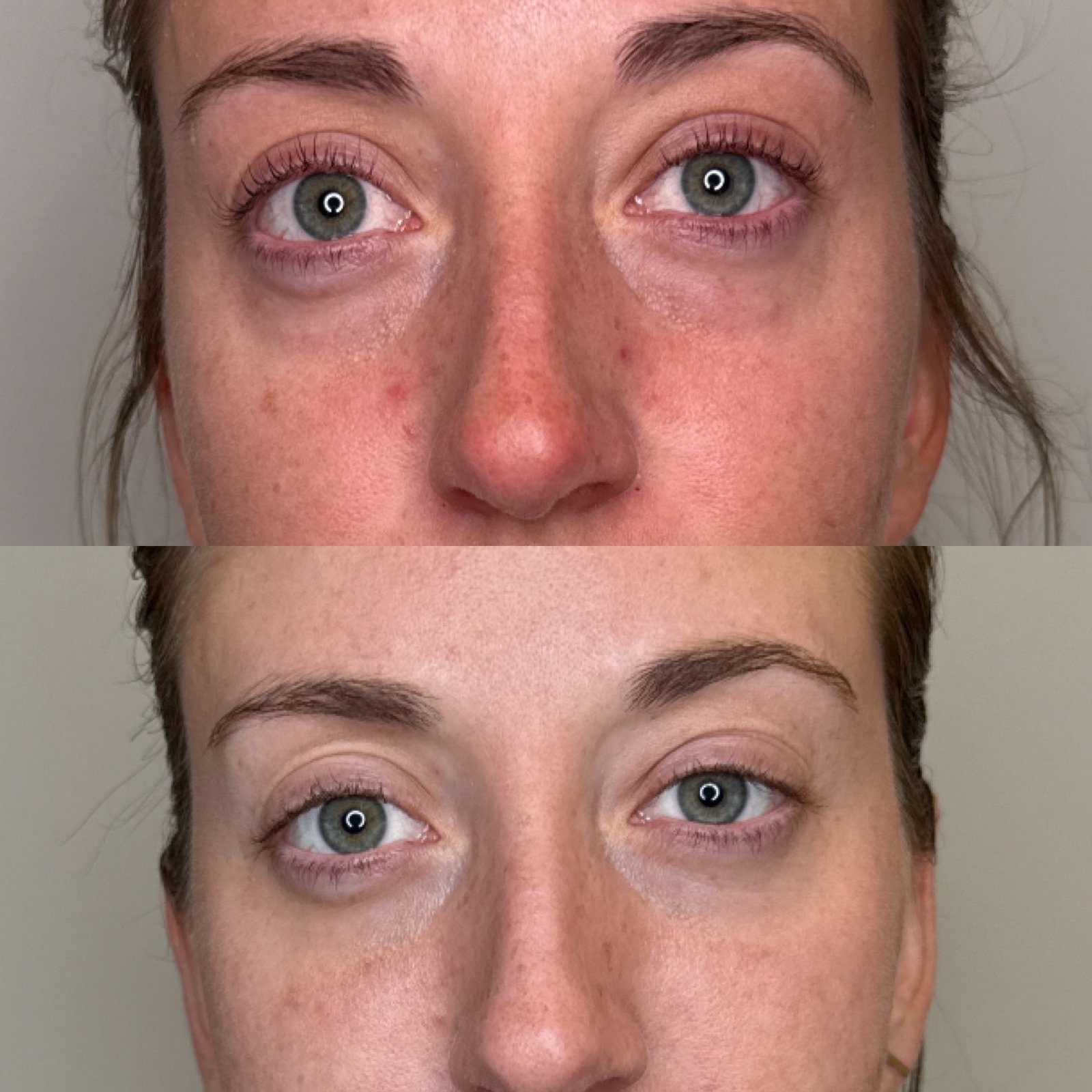 EZ Gel PRF treatment in Denver, Colorado at Skin! Medical Aesthetics