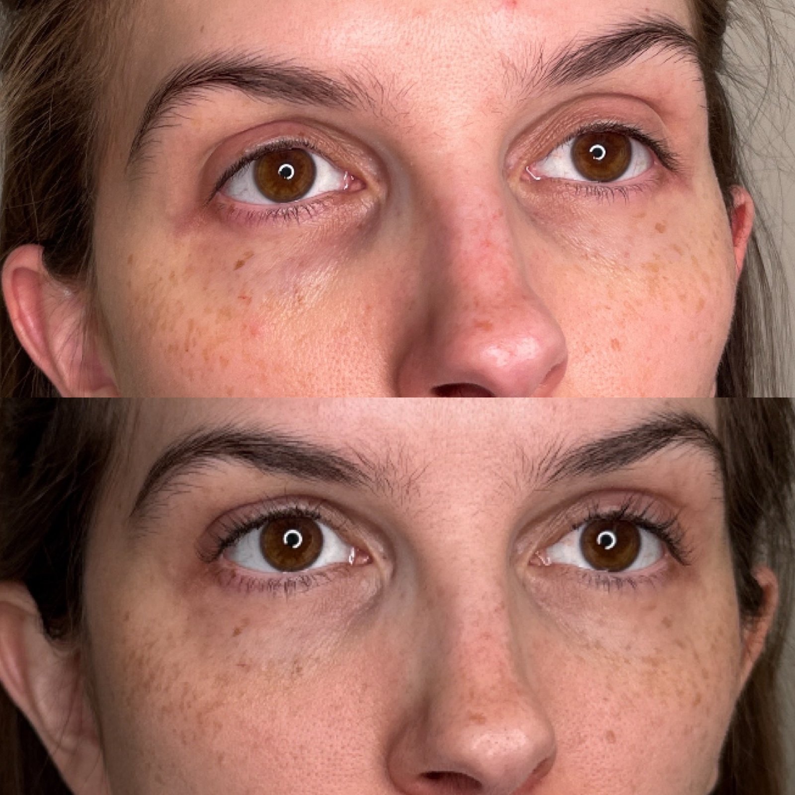 EZ Gel PRF before and after in Denver — crepey under-eye skin