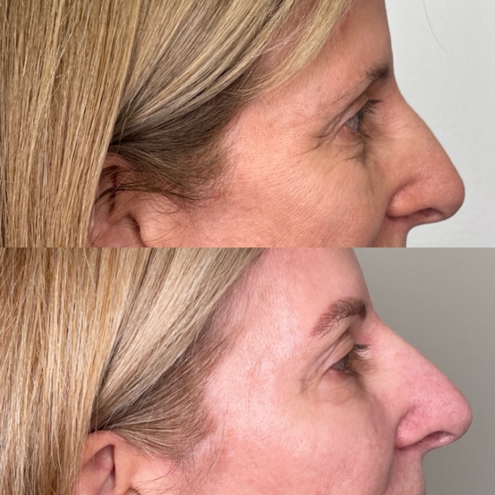 SkinPen microneedling before and after — fine lines