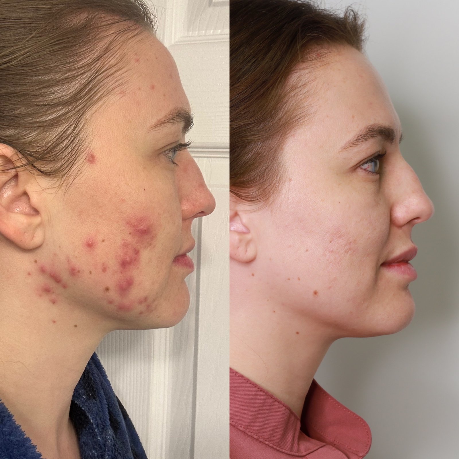 SkinPen microneedling before and after — acne scarring