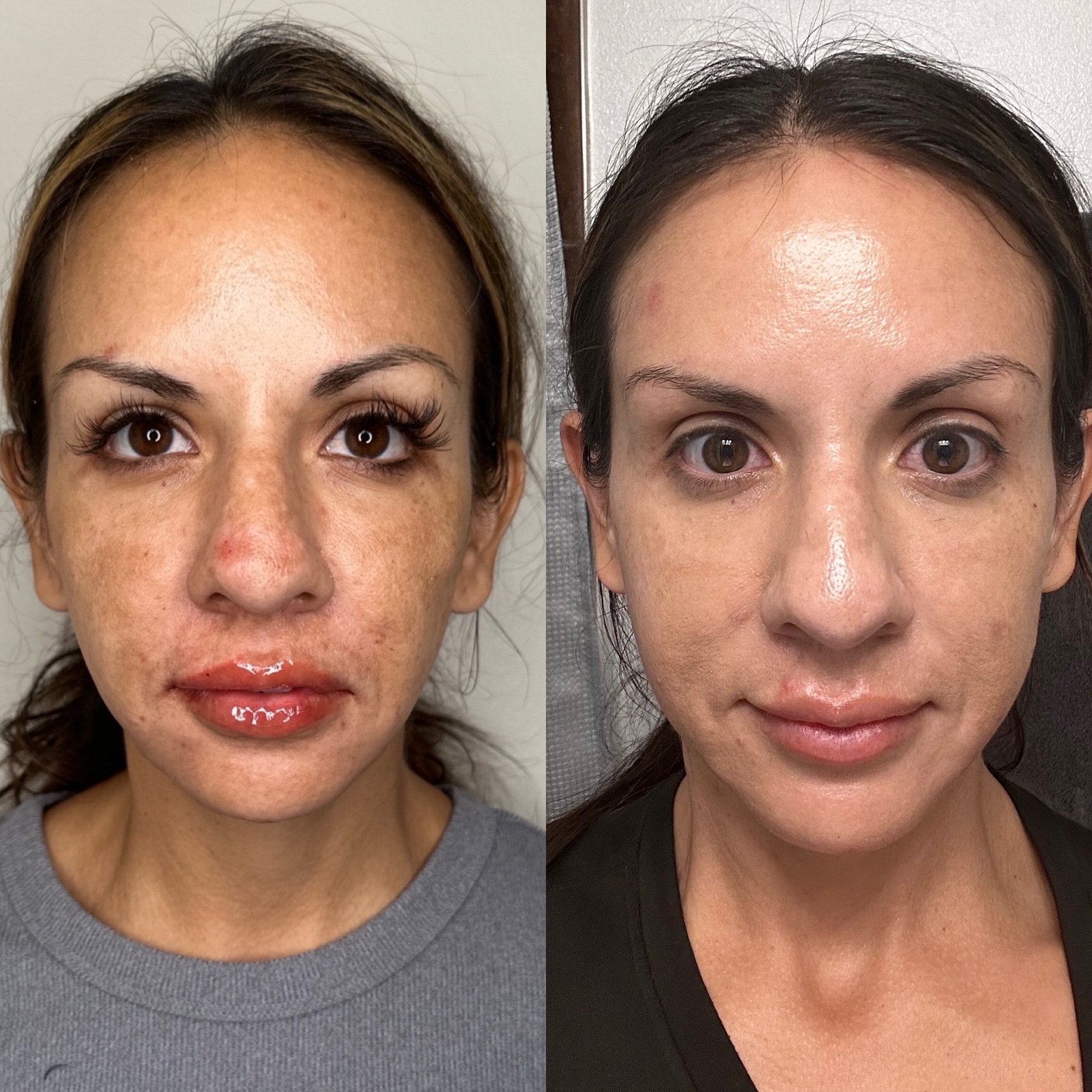 Aerolase Neo Elite before and after — melasma and sun damage