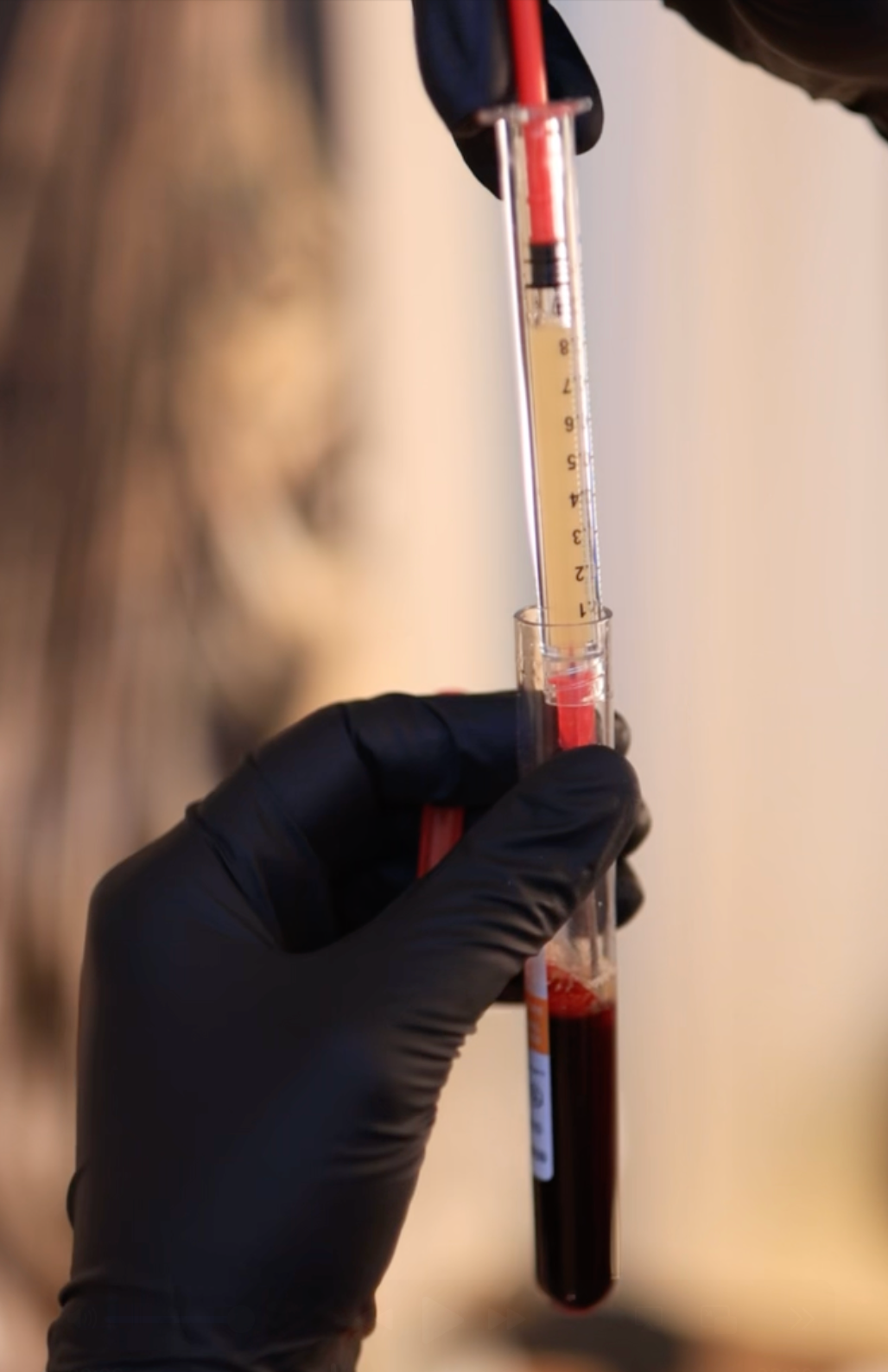 EZ Gel PRF prepared from a patient's own blood at Skin! Medical Aesthetics in Denver