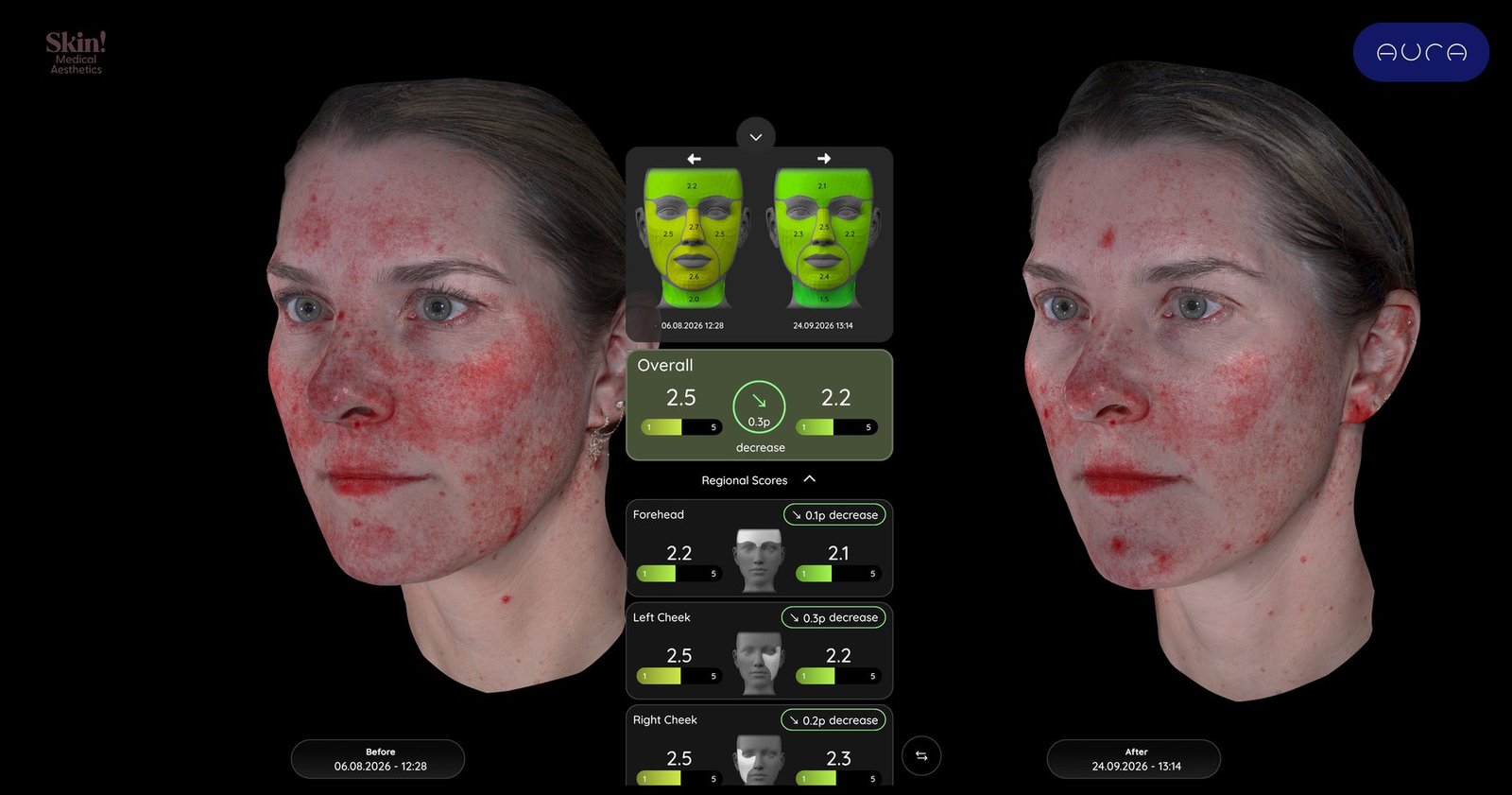 Before and after Aura red views of the same patient, August 6 and September 24, 2026, with overall redness score decreasing from 2.5 to 2.2