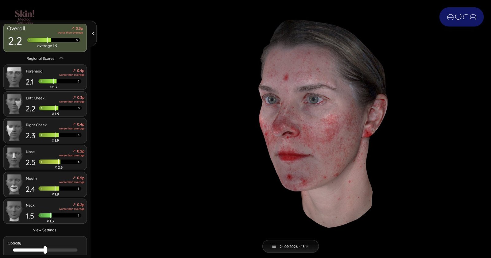 Aura red view highlighting redness across the cheeks, nose, and chin, with regional redness scores