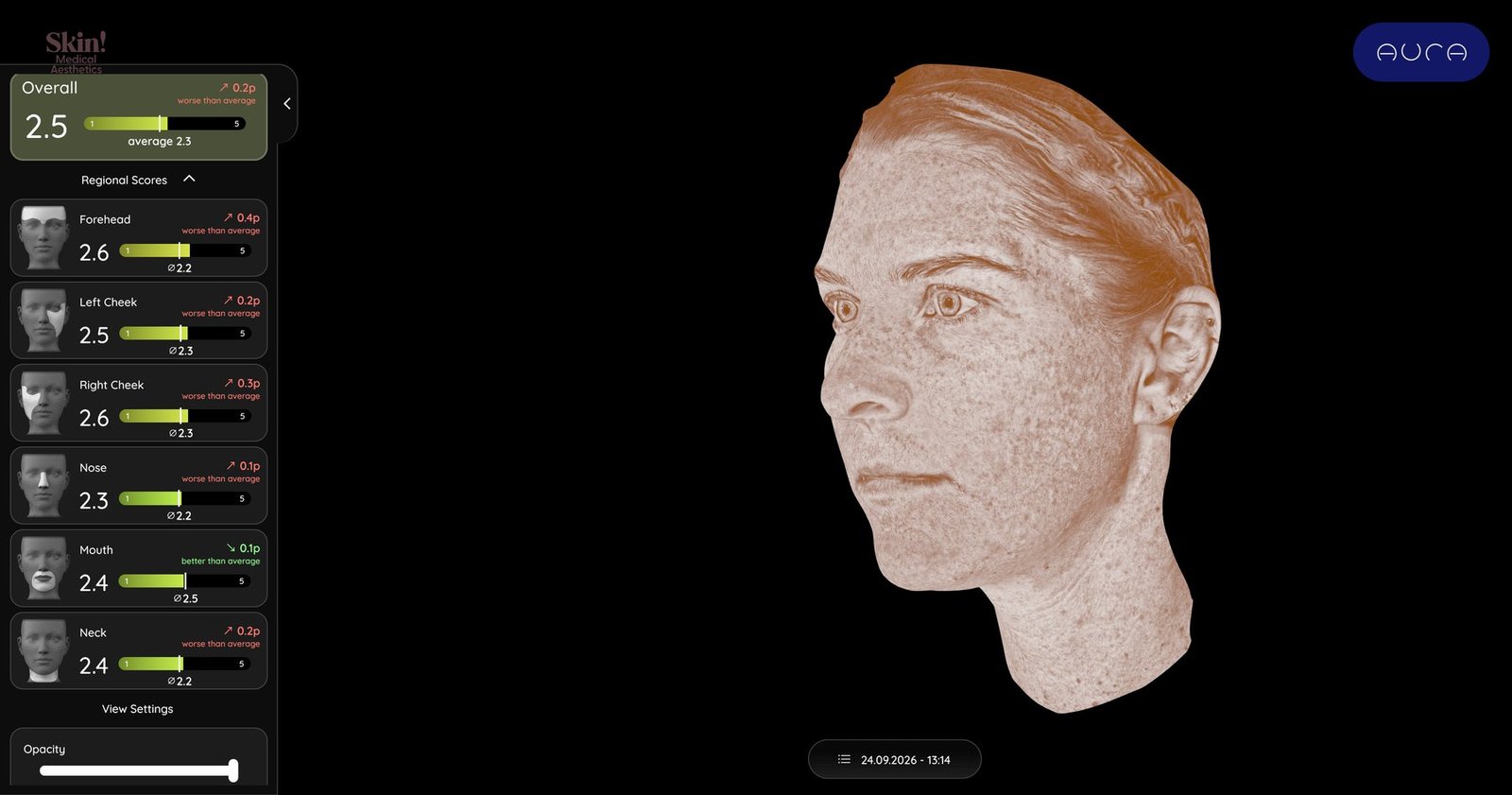 Aura brown view showing pigmentation across the face and neck, with regional brown spot scores