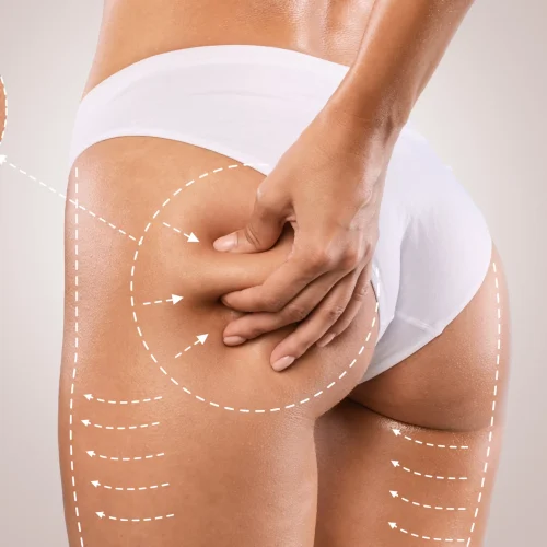 Cellulite-Treatment-scaled.webp