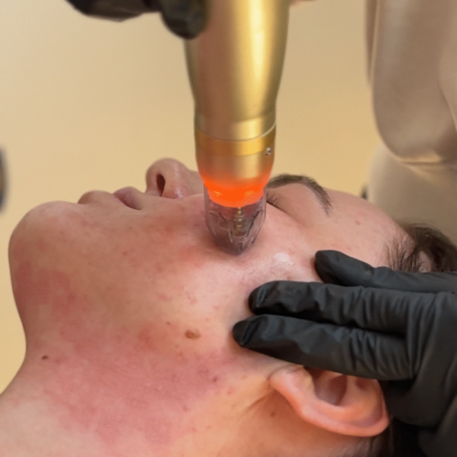 SylfirmX RF microneedling treatment in Denver 80205 at Skin! Medical Aesthetics for skin tightening, texture improvement, and collagen stimulation.