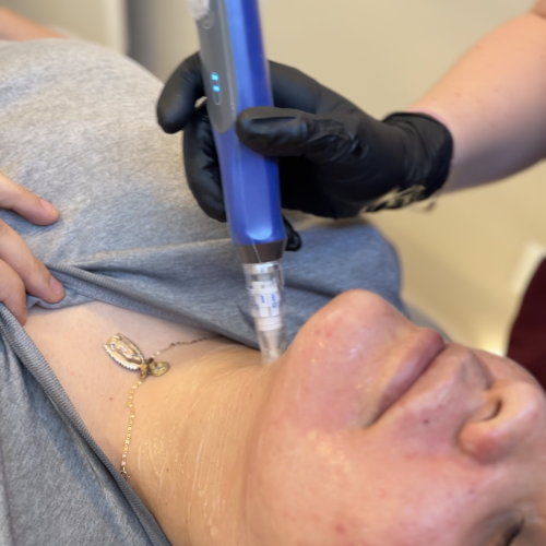 SkinPen microneedling treatment at Skin! Medical Aesthetics in Denver 80205 to improve acne scars, fine lines, wrinkles, and skin texture.